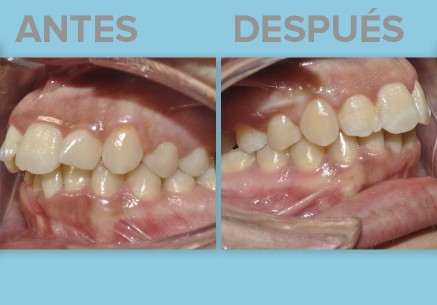 Ortodoncia en Dentibeca